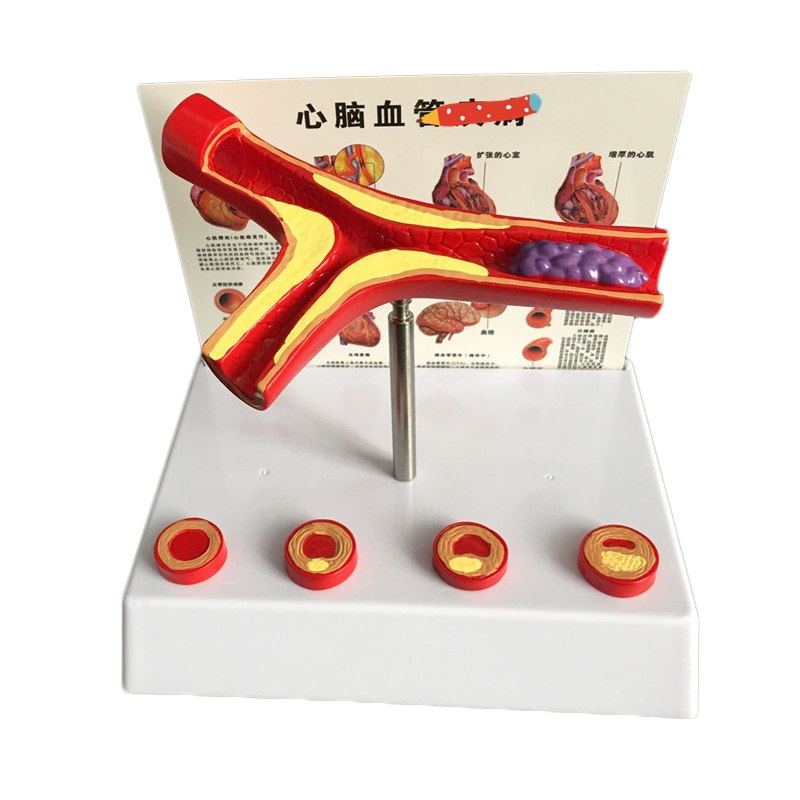 Medical Lab Supplies - 50-fach vergrößertes menschliches Gefäß, Atherosklerose, Gefäßmodell,
